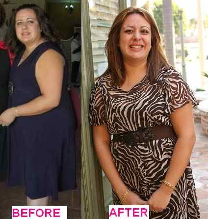 Ericka Before / After bariatric surgery