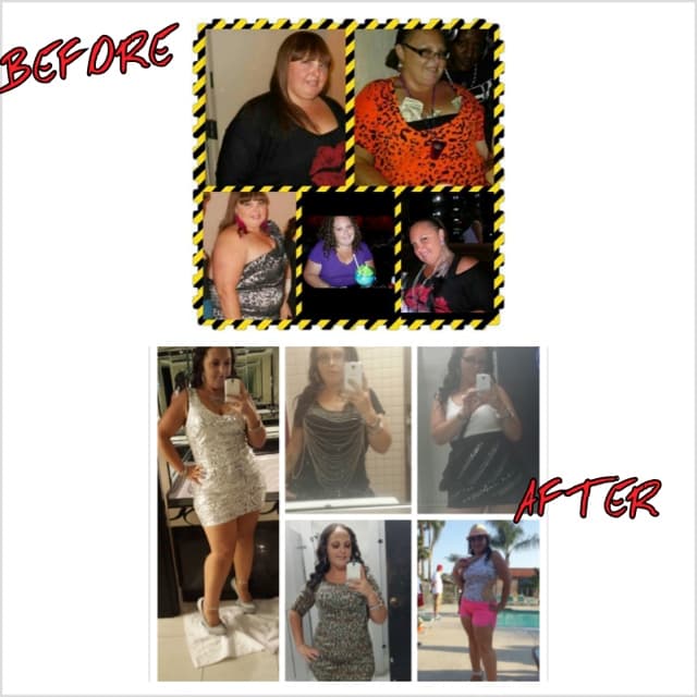 Kara Before / After bariatric surgery