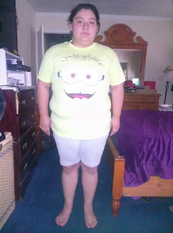IJ before bariatric surgery